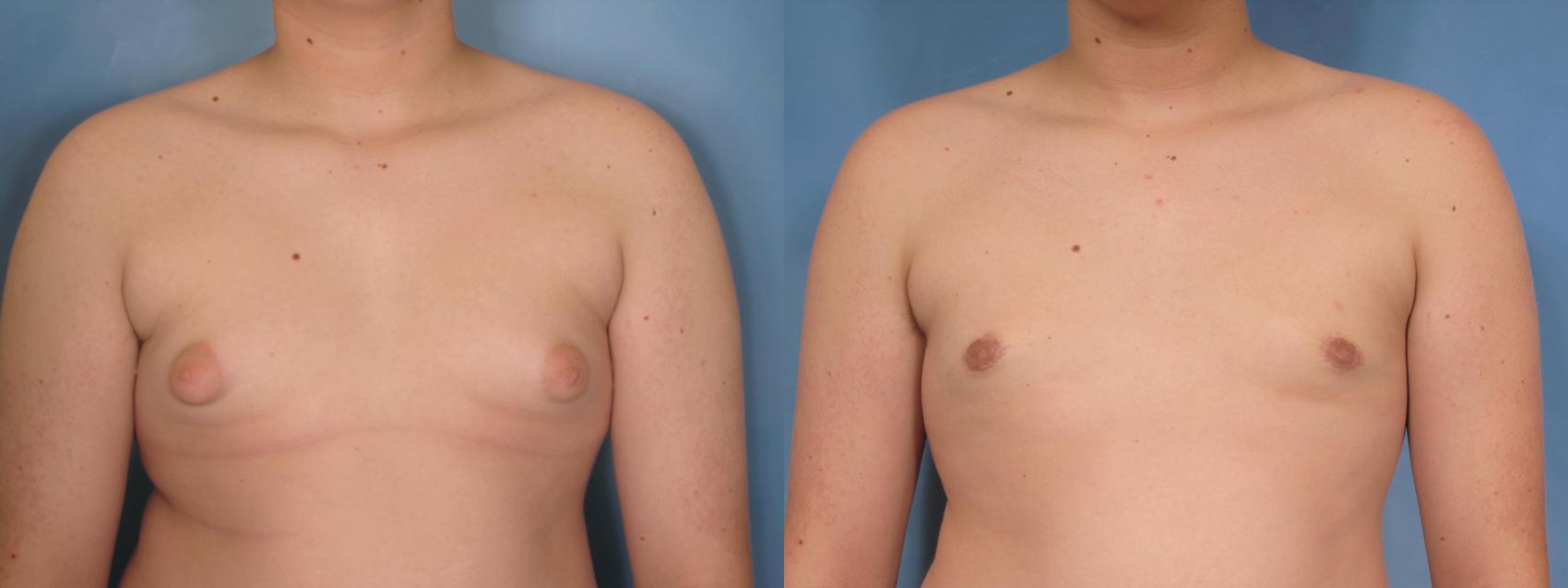 Before & After Gynecomastia Case 86 View #1 View in Naples and Ft. Myers, FL
