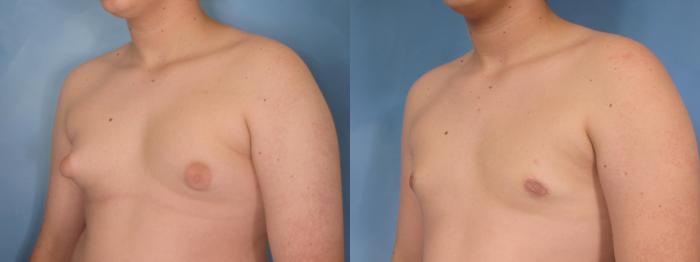 Before & After Gynecomastia Case 86 View #2 View in Naples and Ft. Myers, FL
