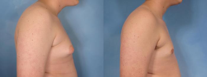 Before & After Gynecomastia Case 86 View #3 View in Naples and Ft. Myers, FL