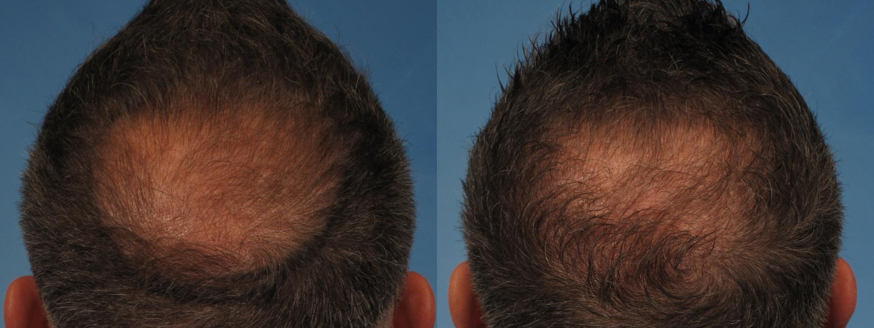 Hair Restoration Before and After Pictures Case 227 | Naples and Ft. Myers, FL | Kent V. Hasen, MD: Aesthetic Plastic Surgery & Med Spa of Naples Hair Restoration Before and After Pictures Case 227 | Naples and Ft. Myers, FL | Kent V. Hasen, MD: Aesthetic Plastic Surgery & Med Spa of Naples