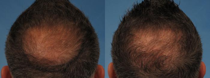Before & After Hair Restoration Case 227 View #2 View in Naples and Ft. Myers, FL