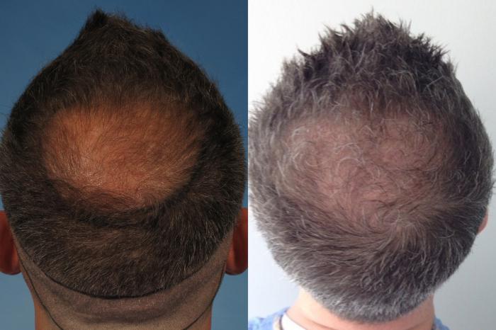 Before & After Hair Restoration Case 227 View #3 View in Naples and Ft. Myers, FL