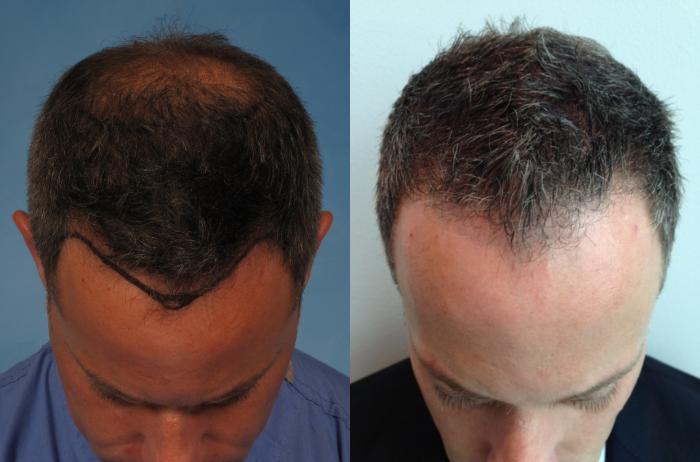 Before & After NeoGraft Hair Transplant Case 227 View #4 View in Naples and Ft. Myers, FL