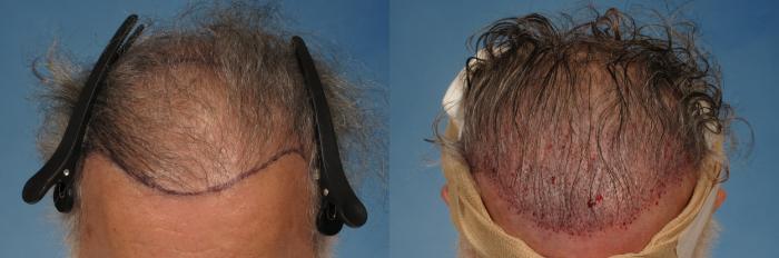 Before & After Hair Restoration Case 267 View #1 View in Naples and Ft. Myers, FL