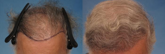 Before & After Hair Restoration Case 267 View #2 View in Naples and Ft. Myers, FL