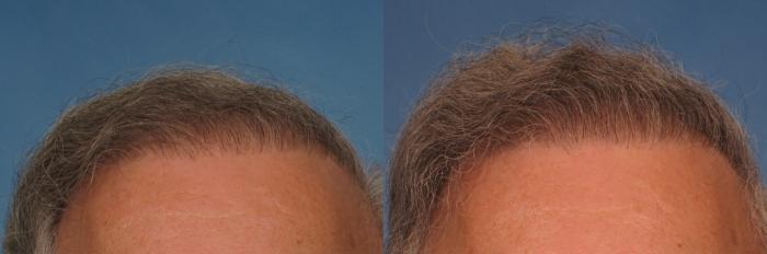 Before & After NeoGraft Hair Transplant Case 267 View #3 View in Naples and Ft. Myers, FL