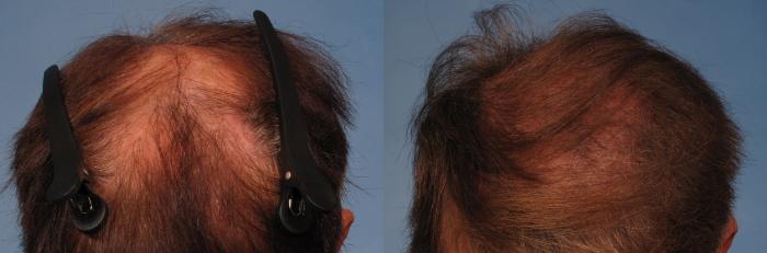 Before & After Hair Restoration Case 268 View #2 View in Naples and Ft. Myers, FL