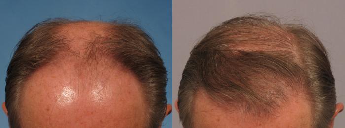 Before & After Hair Restoration Case 274 View #1 View in Naples and Ft. Myers, FL
