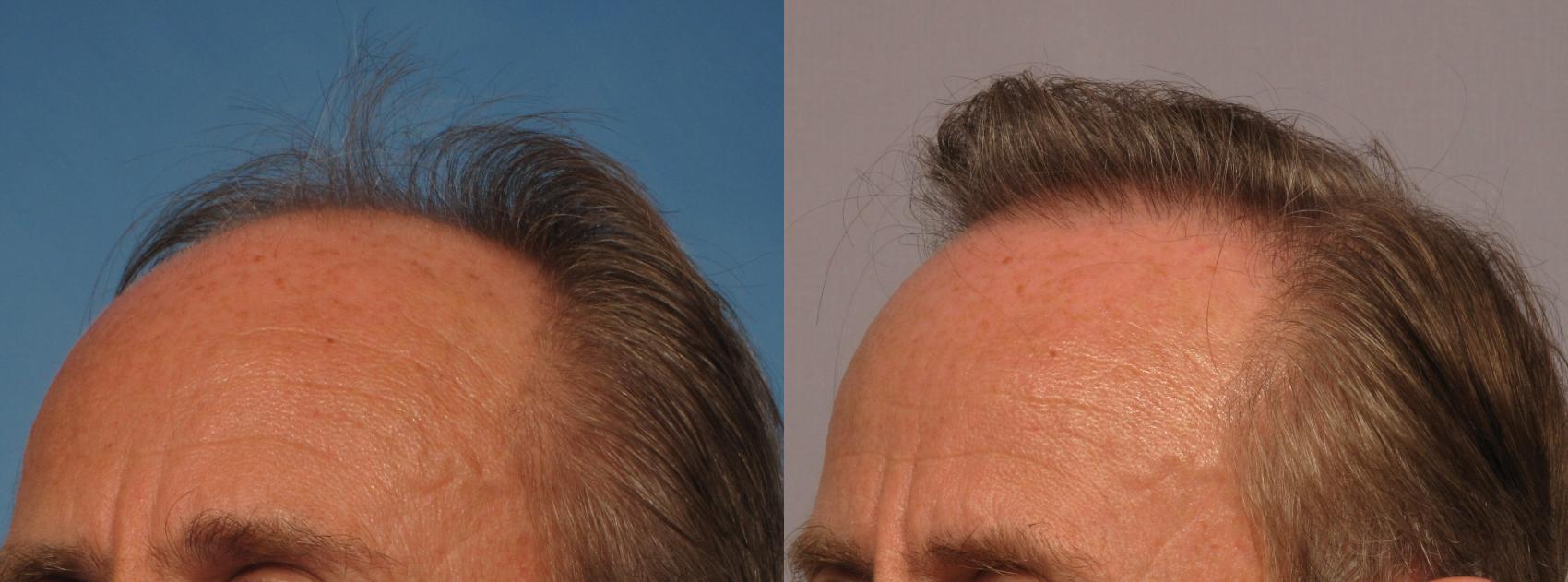 Before & After Hair Restoration Case 274 View #3 View in Naples and Ft. Myers, FL