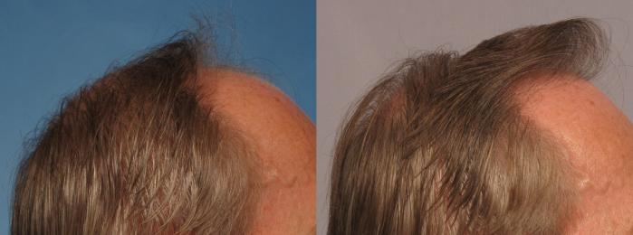 Before & After Hair Restoration Case 274 View #6 View in Naples and Ft. Myers, FL
