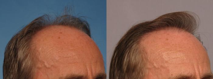 Before & After Hair Restoration Case 274 View #7 View in Naples and Ft. Myers, FL