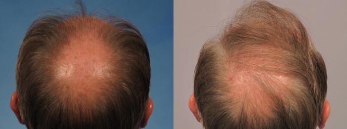 Before & After Hair Restoration Case 274 View #8 View in Naples and Ft. Myers, FL