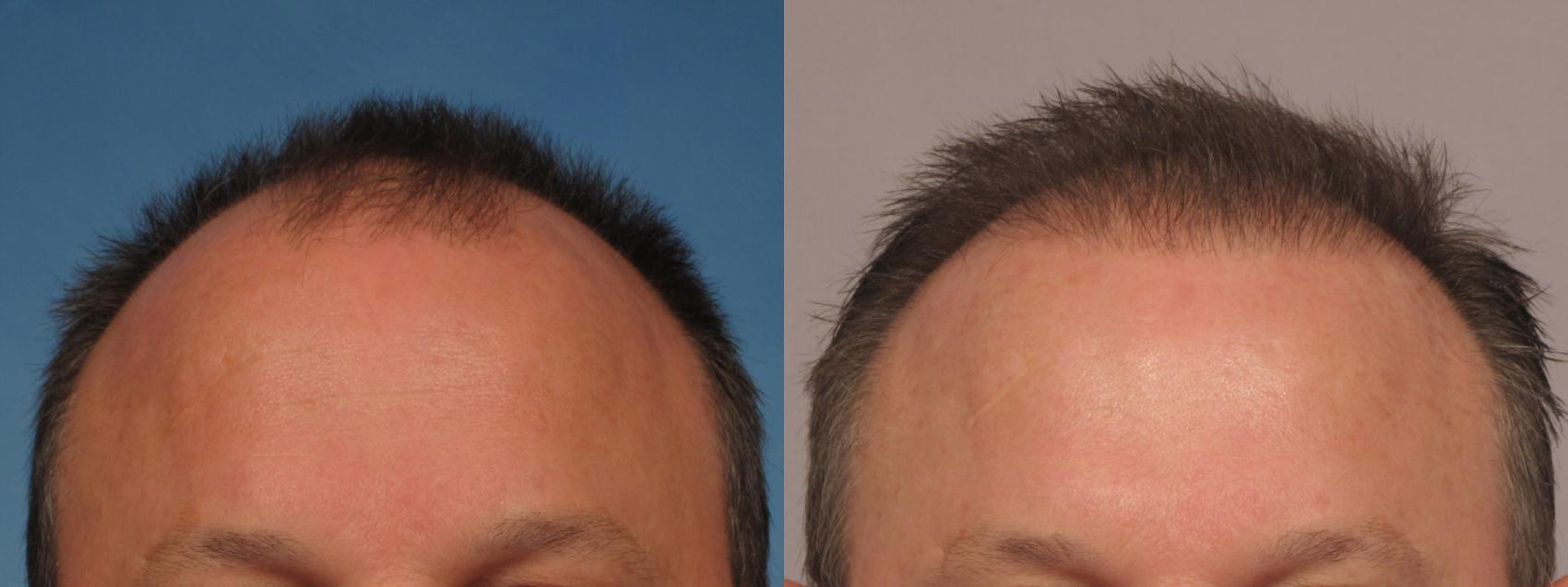 Pre-Treatment Frontal View of NeoGraft Patient by Dr. Kent Hasen