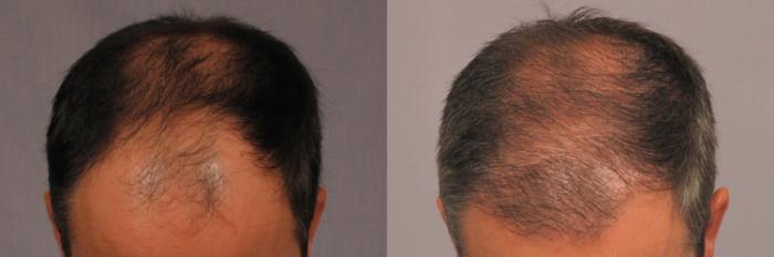 Before & After Hair Restoration Case 297 View #1 View in Naples and Ft. Myers, FL