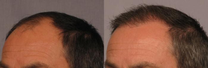 Before & After Hair Restoration Case 297 View #2 View in Naples and Ft. Myers, FL