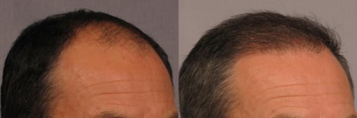 Before & After NeoGraft Hair Transplant Case 297 View #3 View in Naples and Ft. Myers, FL