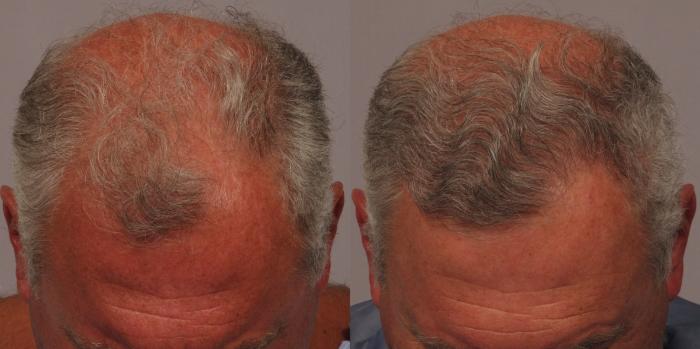 Pre-Treatment Front View of 63-year-old man NeoGraft Hair Restoration by Dr. Kent Hasen