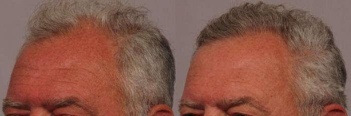 Pre-Treatment Left Oblique View of 63-year-old man NeoGraft Hair Restoration by Dr. Kent Hasen