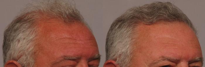 Pre-Treatment Right Oblique View of 63-year-old man NeoGraft Hair Restoration by Dr. Kent Hasen