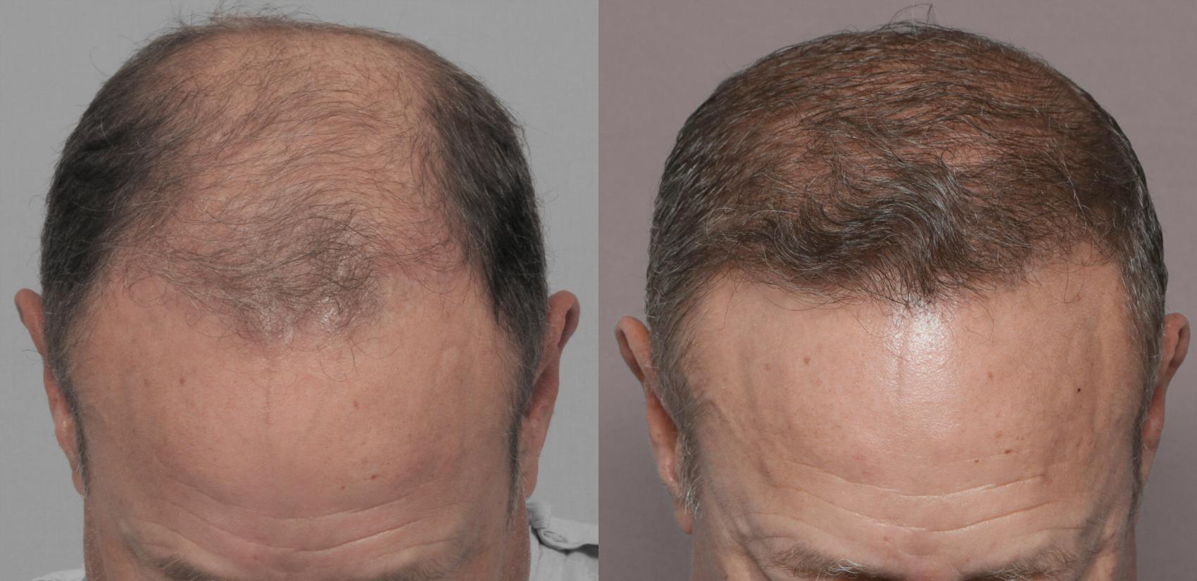 Pre-Treatment Frontal View of NeoGraft Hair Restoration by Dr. Hasen