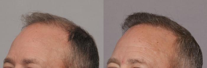 Pre-Treatment Left Oblique View of NeoGraft Hair Restoration by Dr. Hasen