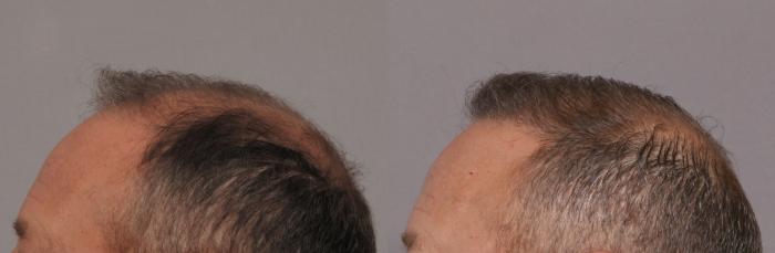 Pre-Treatment Left Side View of NeoGraft Hair Restoration by Dr. Hasen
