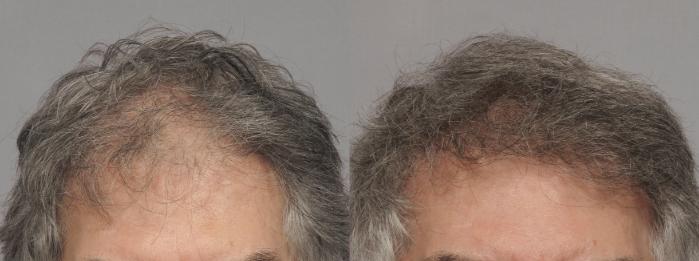 Pre-Treatment Frontal View of NeoGraft Hair Restoration by Dr. Kent Hasen