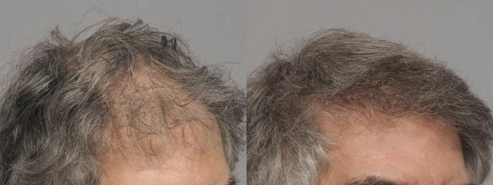 Pre-Treatment Left Oblique View of NeoGraft Hair Restoration by Dr. Kent Hasen