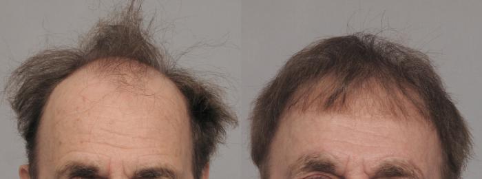Pre-Treatment Frontal View of NeoGraft Hair Restoration