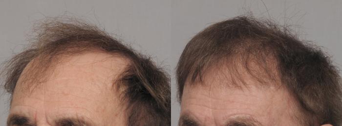 Pre-Treatment Left Oblique View of NeoGraft Hair Restoration
