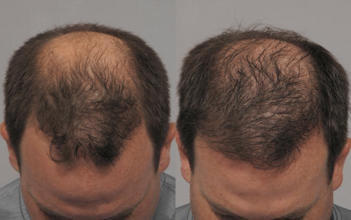 Pre-Treatment Frontal Down View of NeoGraft Hair Restoration