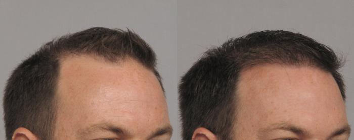 Pre-Treatment Right Oblique View of NeoGraft Hair Restoration