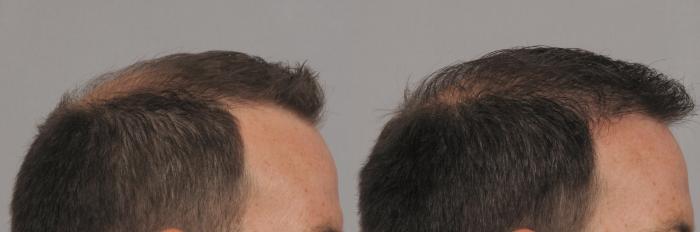 Pre-Treatment Right Side View of NeoGraft Hair Restoration