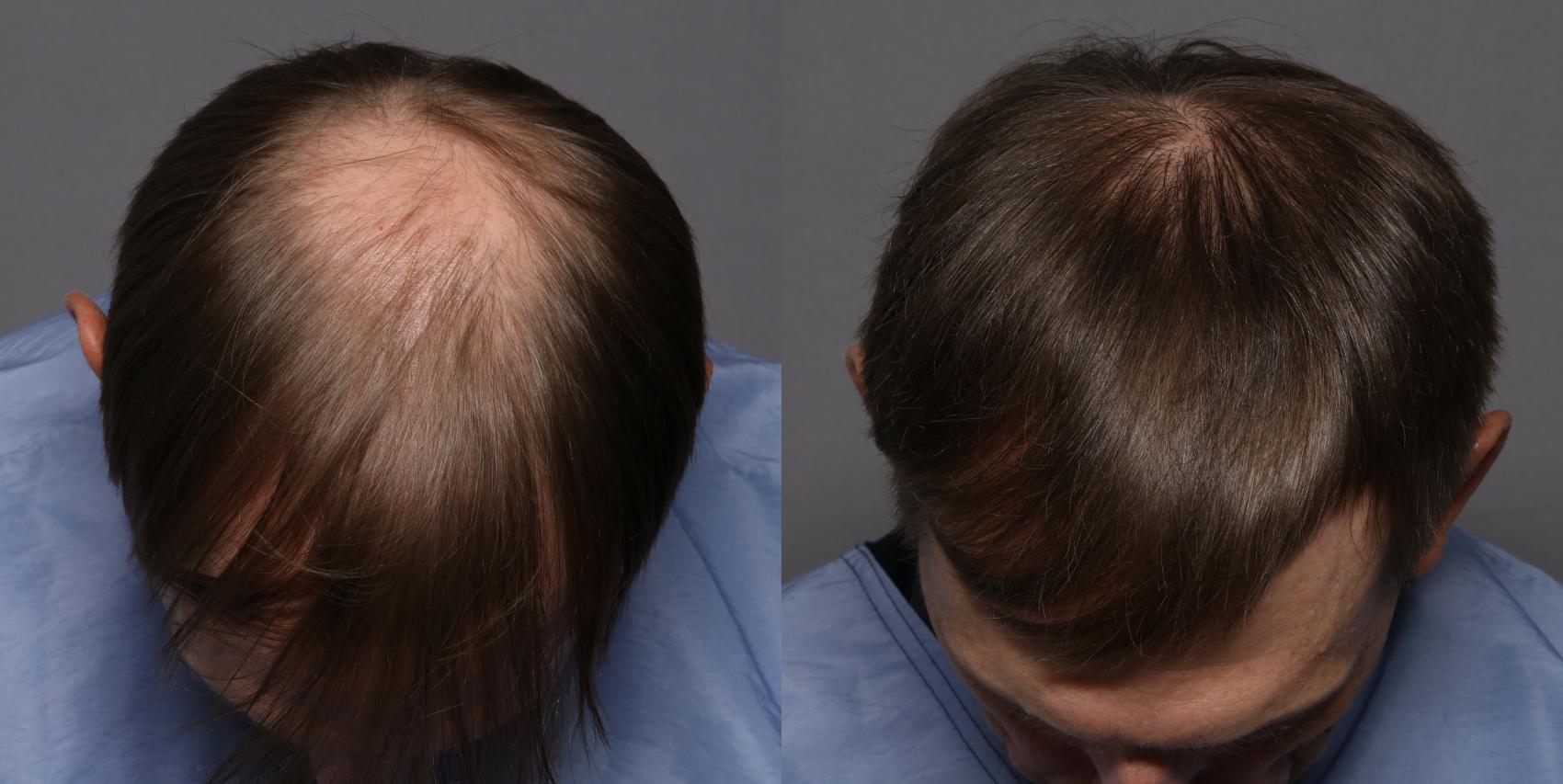 Front Crown, Pre Hair Restoration Treatment