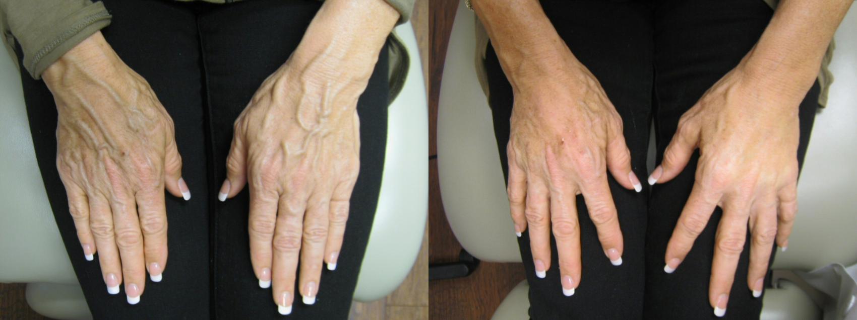 Before & After Hand Wrinkle Filling Case 136 View #1 View in Naples and Ft. Myers, FL