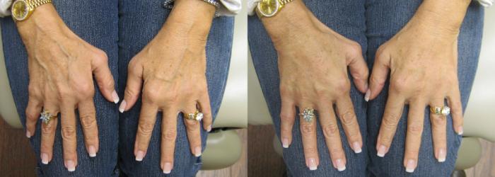 Before & After Hand Wrinkle Filling Case 137 View #1 View in Naples and Ft. Myers, FL