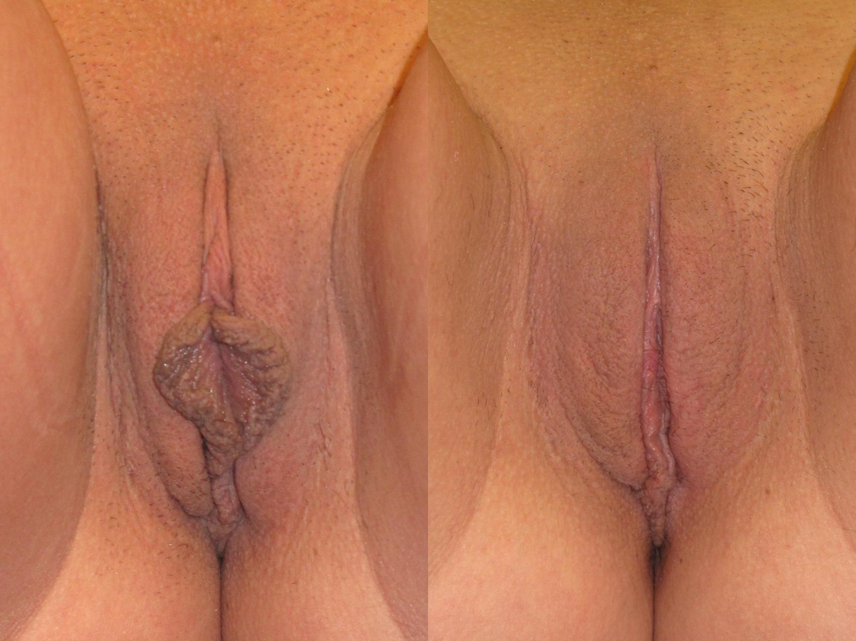 Before & After Labiaplasty Case 225 View #1 View in Naples and Ft. Myers, FL