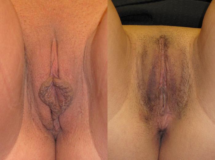 Before & After Labiaplasty Case 225 View #2 View in Naples and Ft. Myers, FL