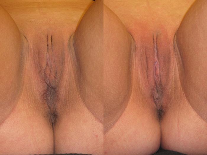 Before & After Labiaplasty Case 226 View #1 View in Naples and Ft. Myers, FL