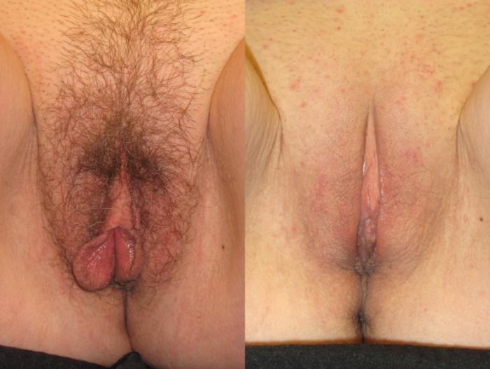 Before & After Labiaplasty Case 259 View #5 View in Naples and Ft. Myers, FL