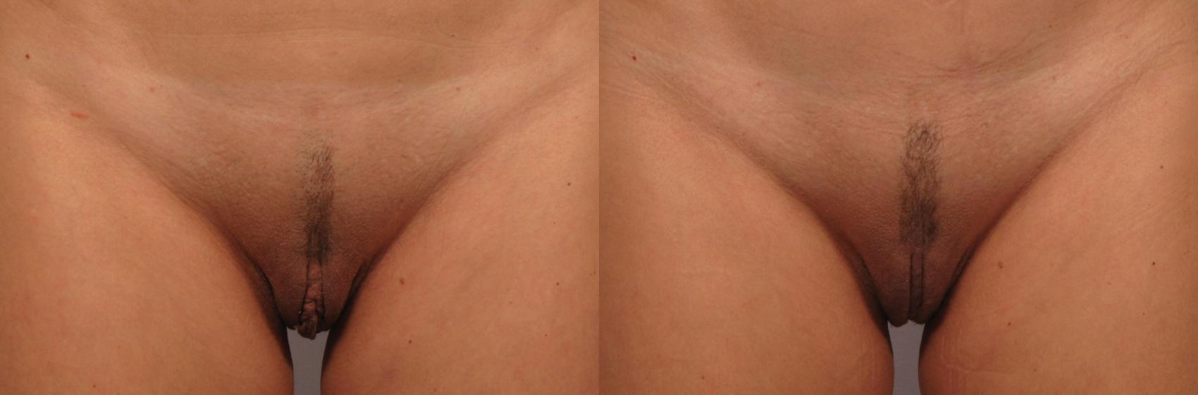 Before & After Labiaplasty Case 302 View #1 View in Naples and Ft. Myers, FL