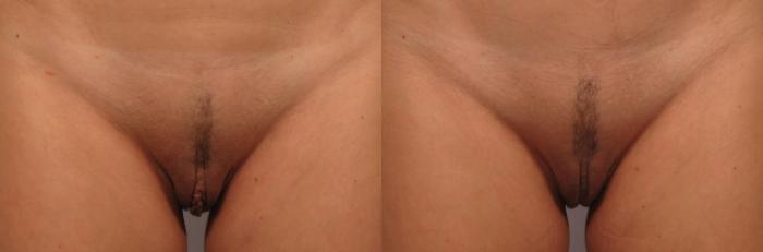 Before & After Labiaplasty Case 302 View #1 View in Naples and Ft. Myers, FL