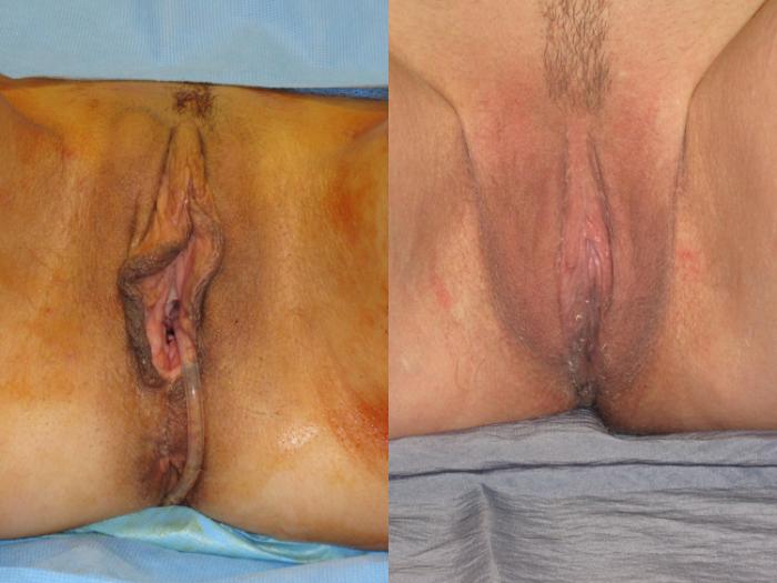 Before & After Labiaplasty Case 302 View #2 View in Naples and Ft. Myers, FL