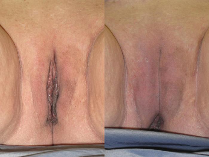 Before & After Labiaplasty Case 303 View #1 View in Naples and Ft. Myers, FL