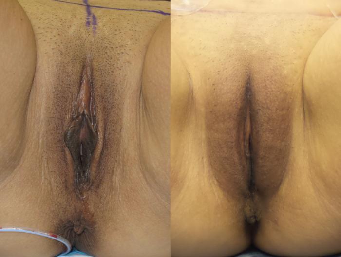 Labiaplasty with Labial Puff, Pre-Op