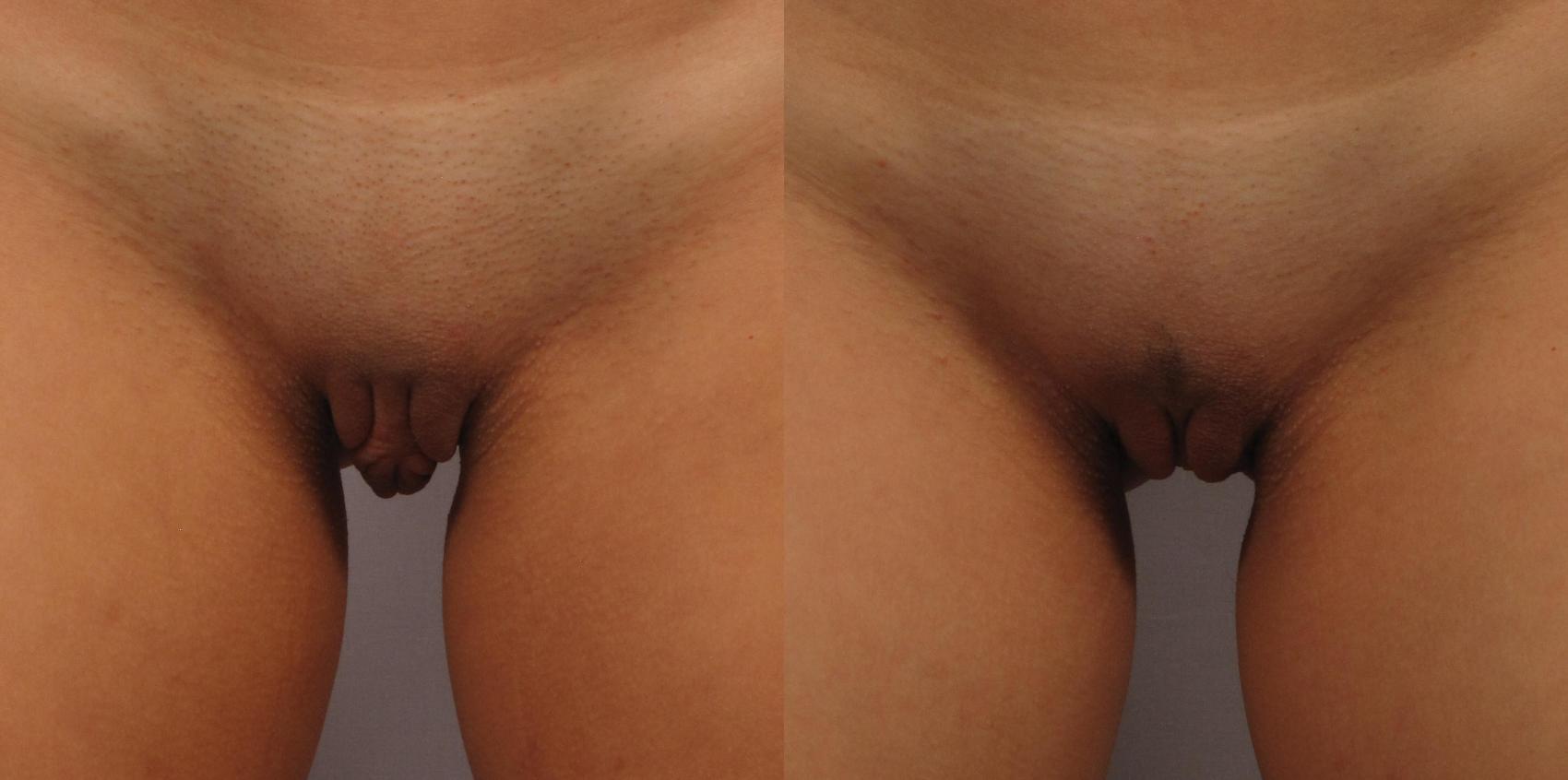 Labiaplasty patient standing frontal before surgery