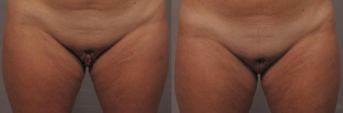 Pre-op frontal standing view before labiaplasty in Naples, Florida
