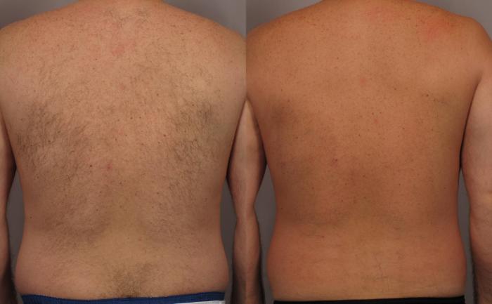 Pre Laser Hair Removal Treatment of Back
