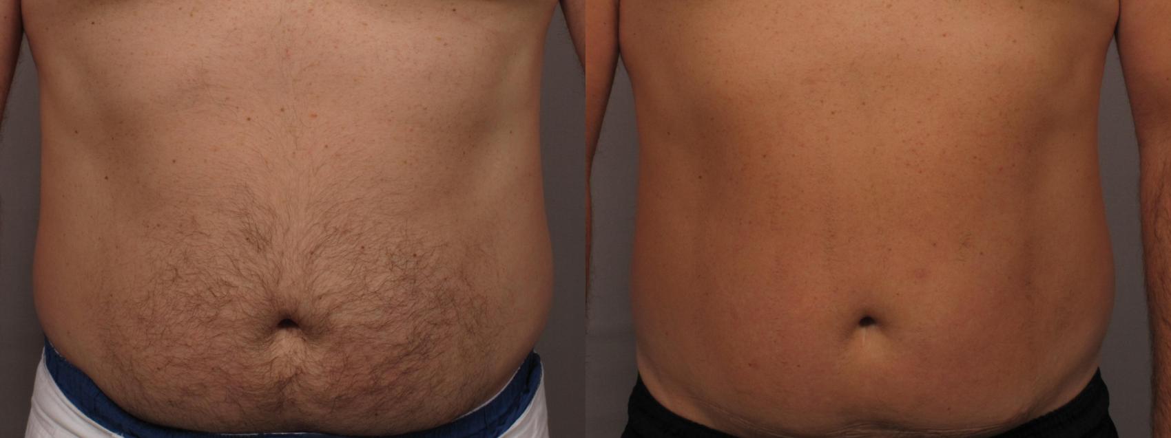 Laser Hair Removal Before and After Photo Gallery | Naples and Ft. Myers,  FL | Kent V. Hasen, MD: Aesthetic Plastic Surgery & Med Spa of Naples