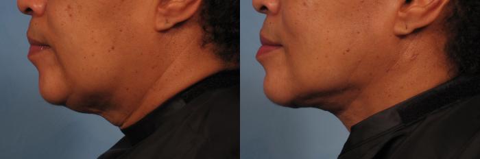 Before & After Laser Neck Lift - Precision Tx Case 265 View #1 View in Naples and Ft. Myers, FL